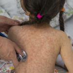 The measles outbreak in the United States is severe.